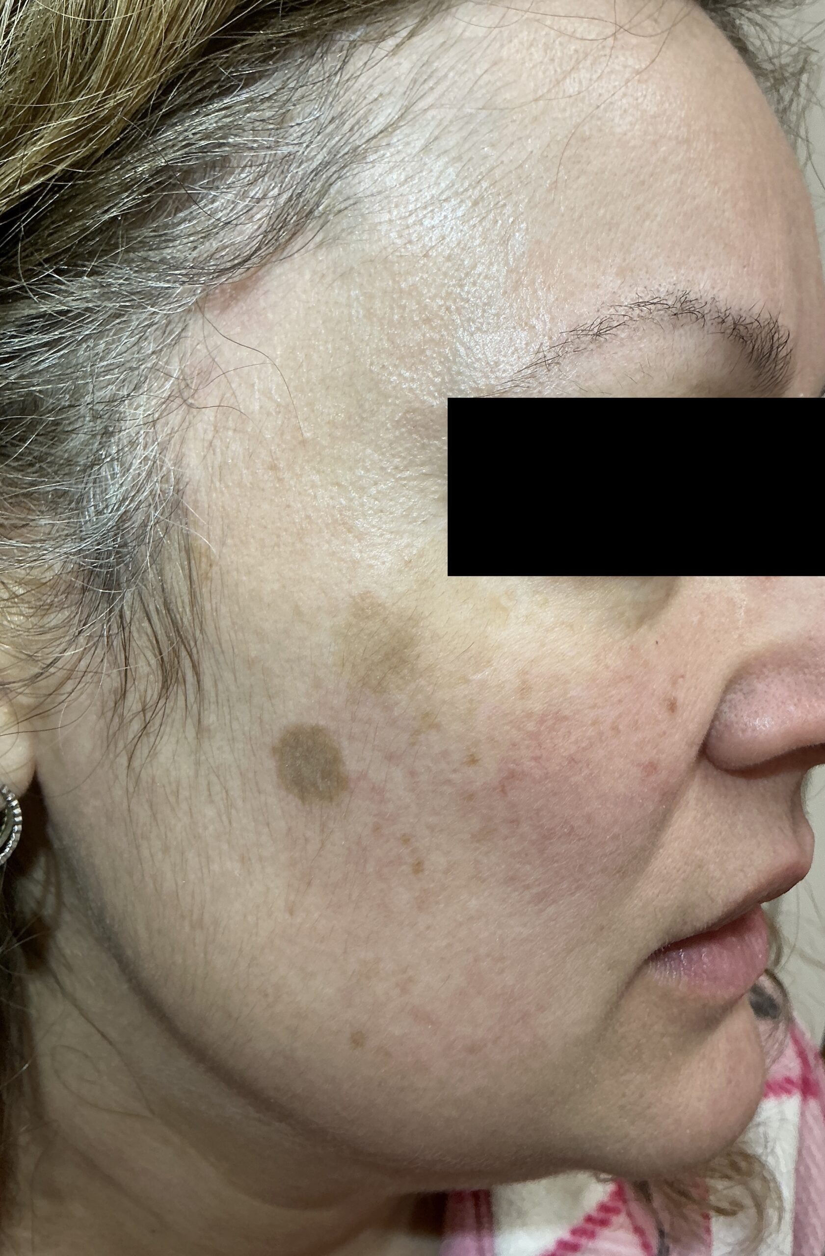 Seborrheic Keratosis & Sunspot Removal — Baseline