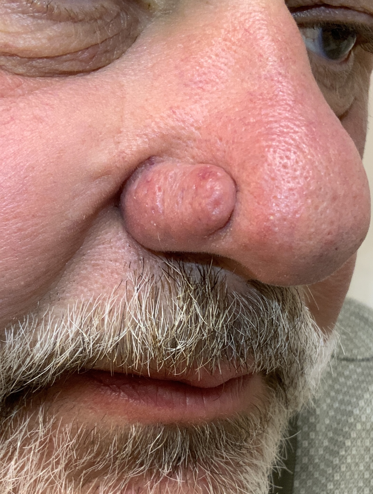 Expert Mole Removal — Baseline