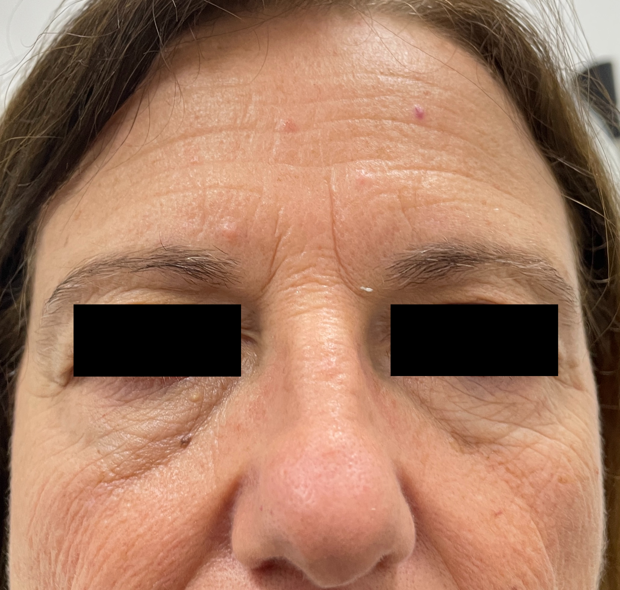 Botox & Dermal Fillers — Baseline