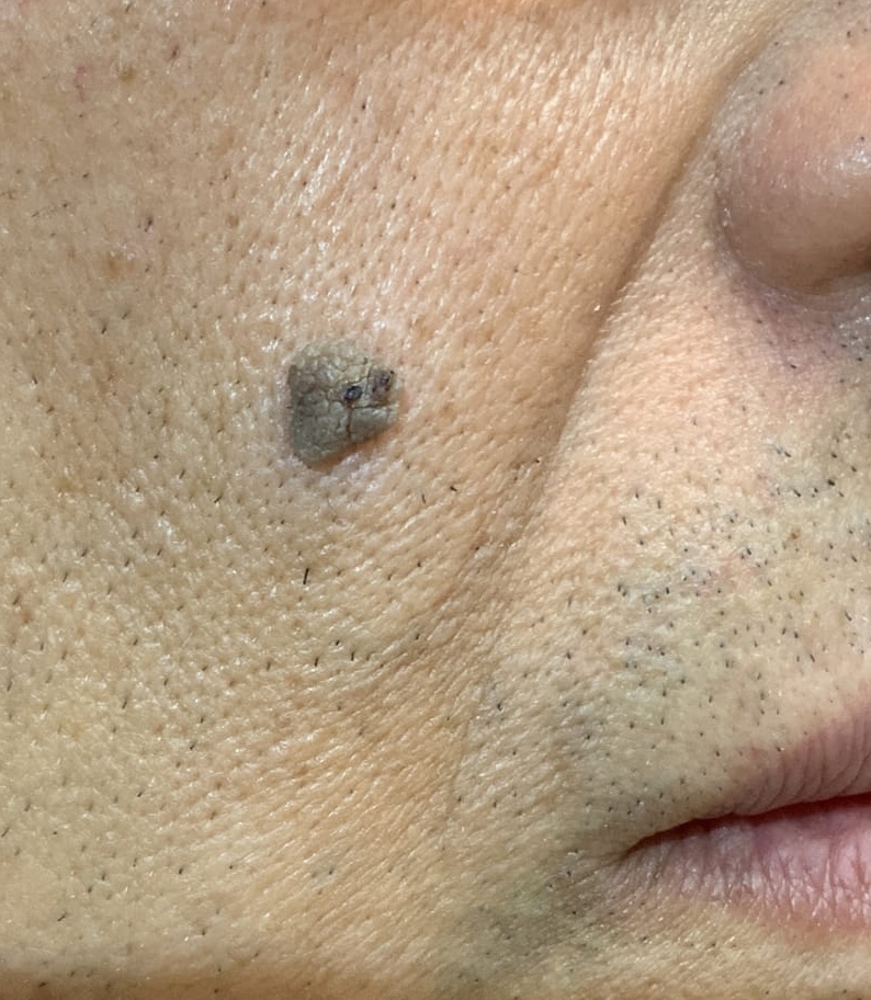 Expert Mole Removal — Baseline