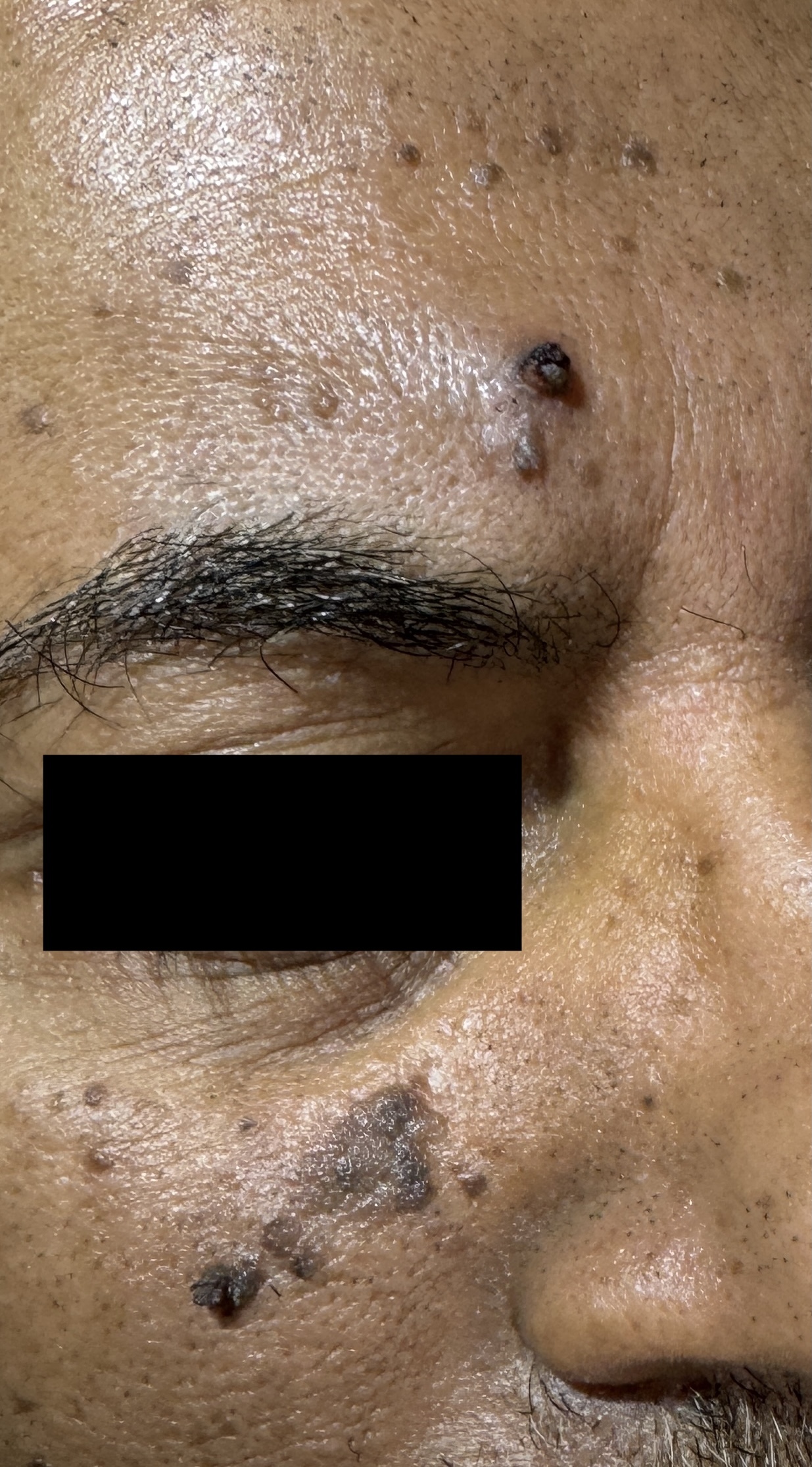 Seborrheic Keratosis & Sunspot Removal — Baseline