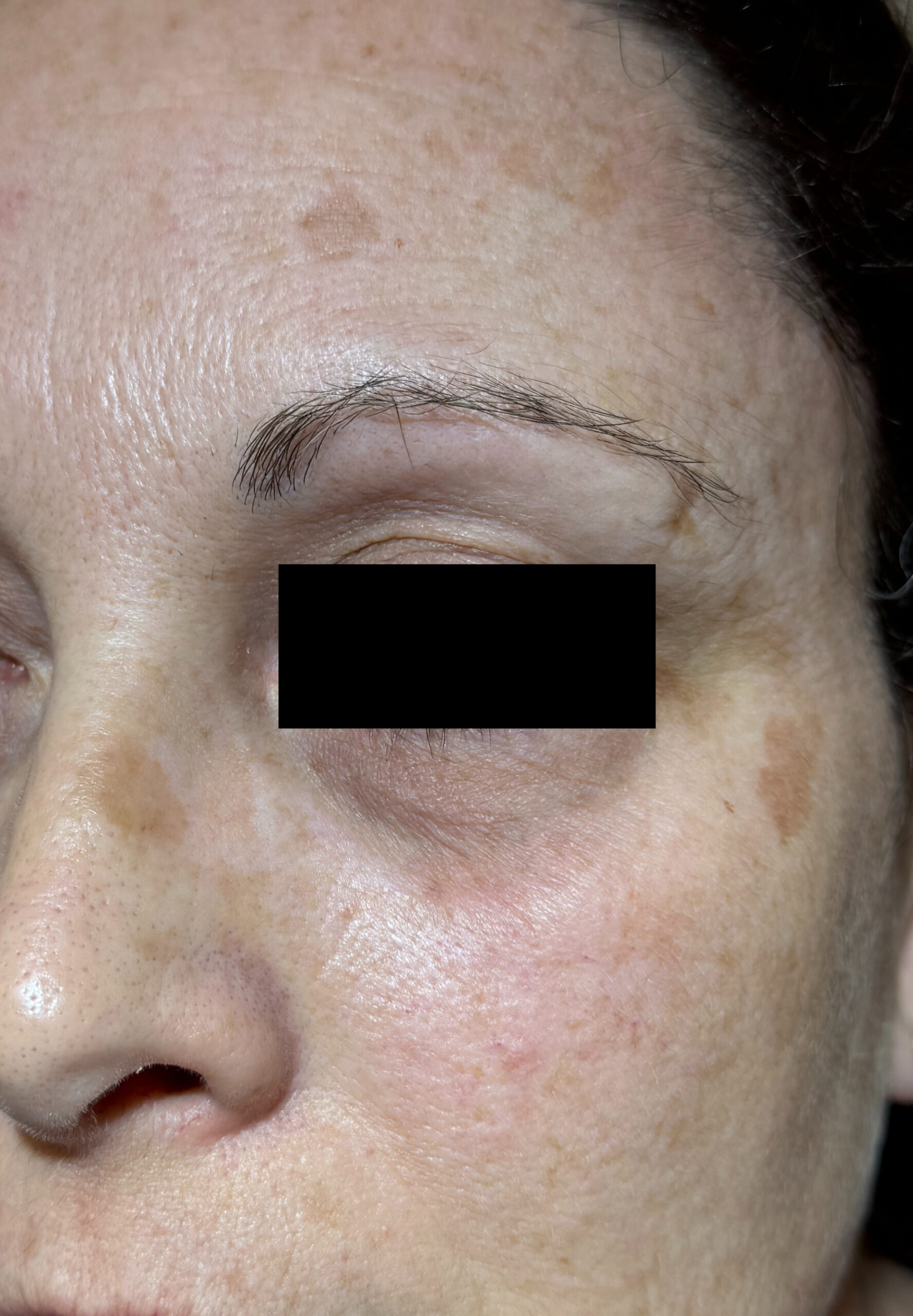 Seborrheic Keratosis & Sunspot Removal — Baseline