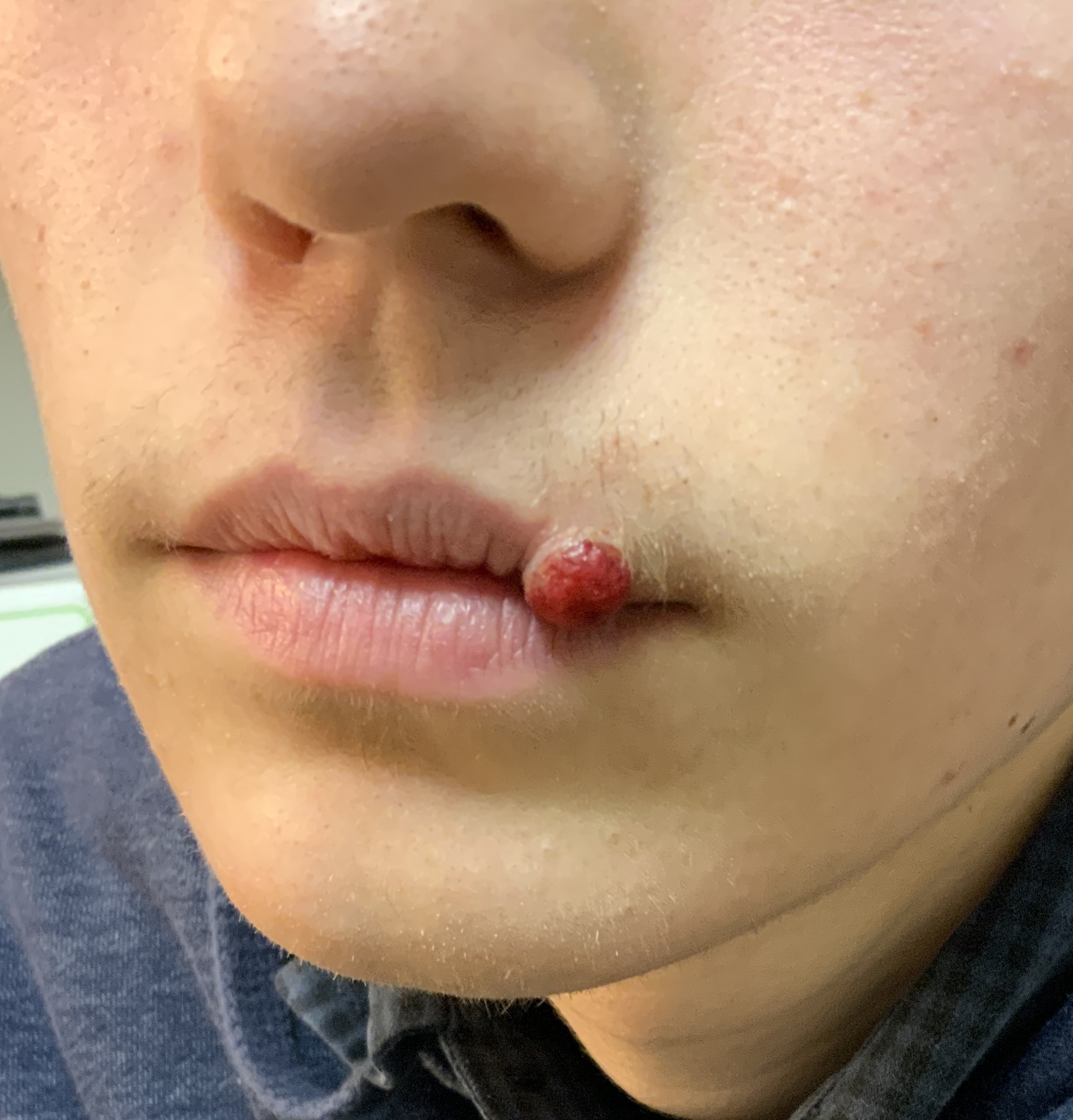 Expert Mole Removal — Baseline