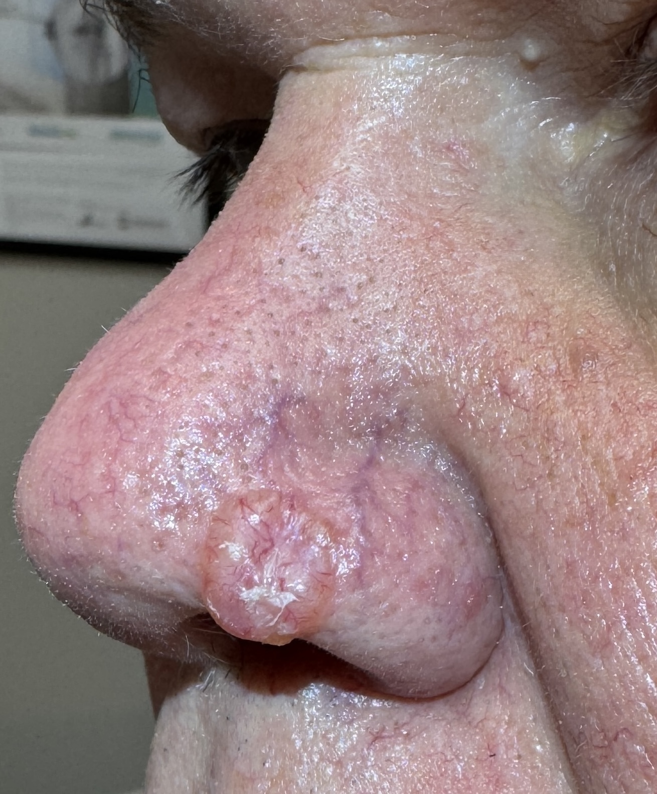Expert Mole Removal — Baseline