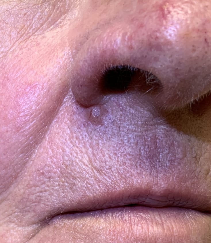 Expert Mole Removal — Baseline