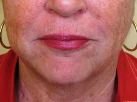 Botox & Dermal Fillers — Two weeks after 5 syringes