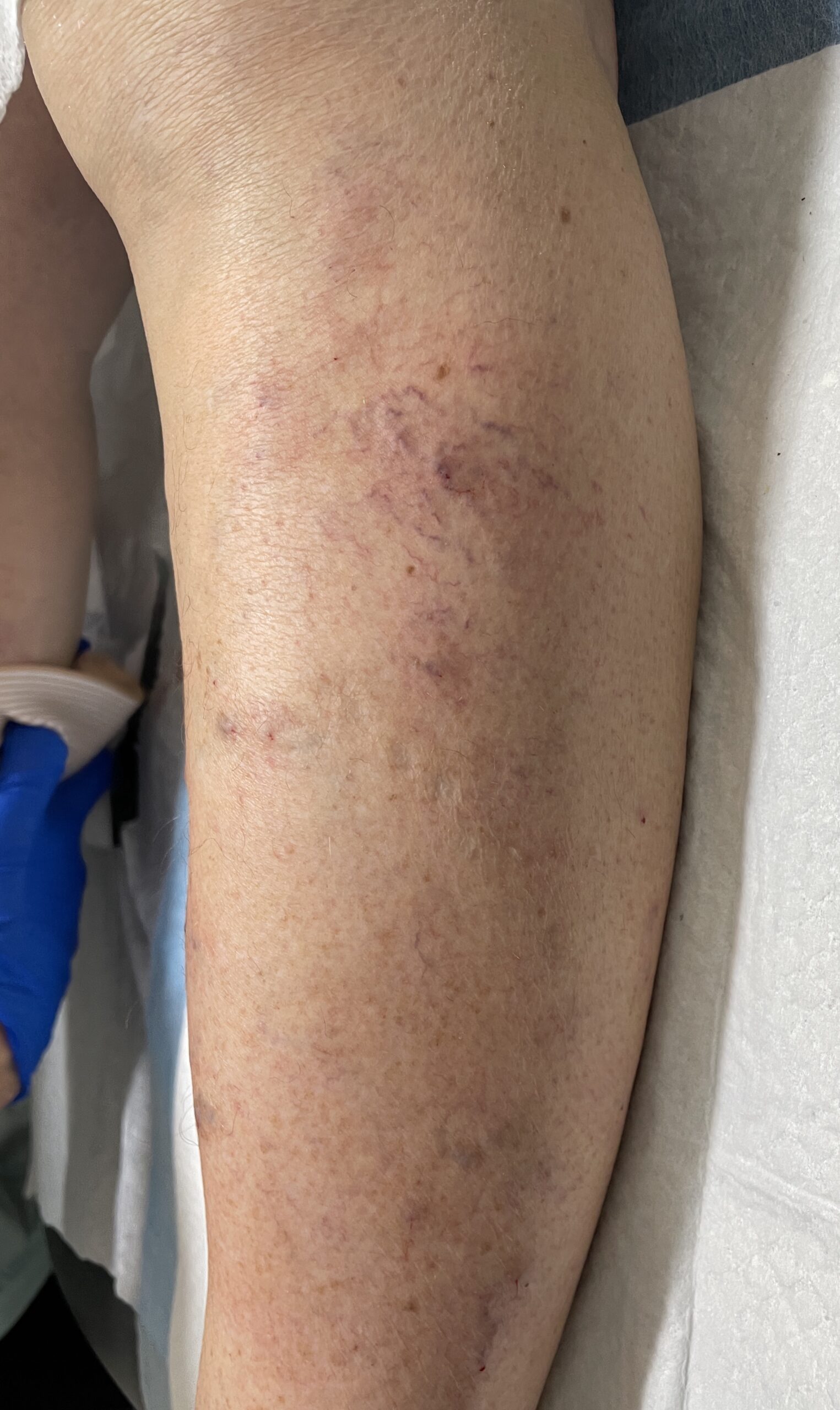 Immediately after injection — left lateral leg