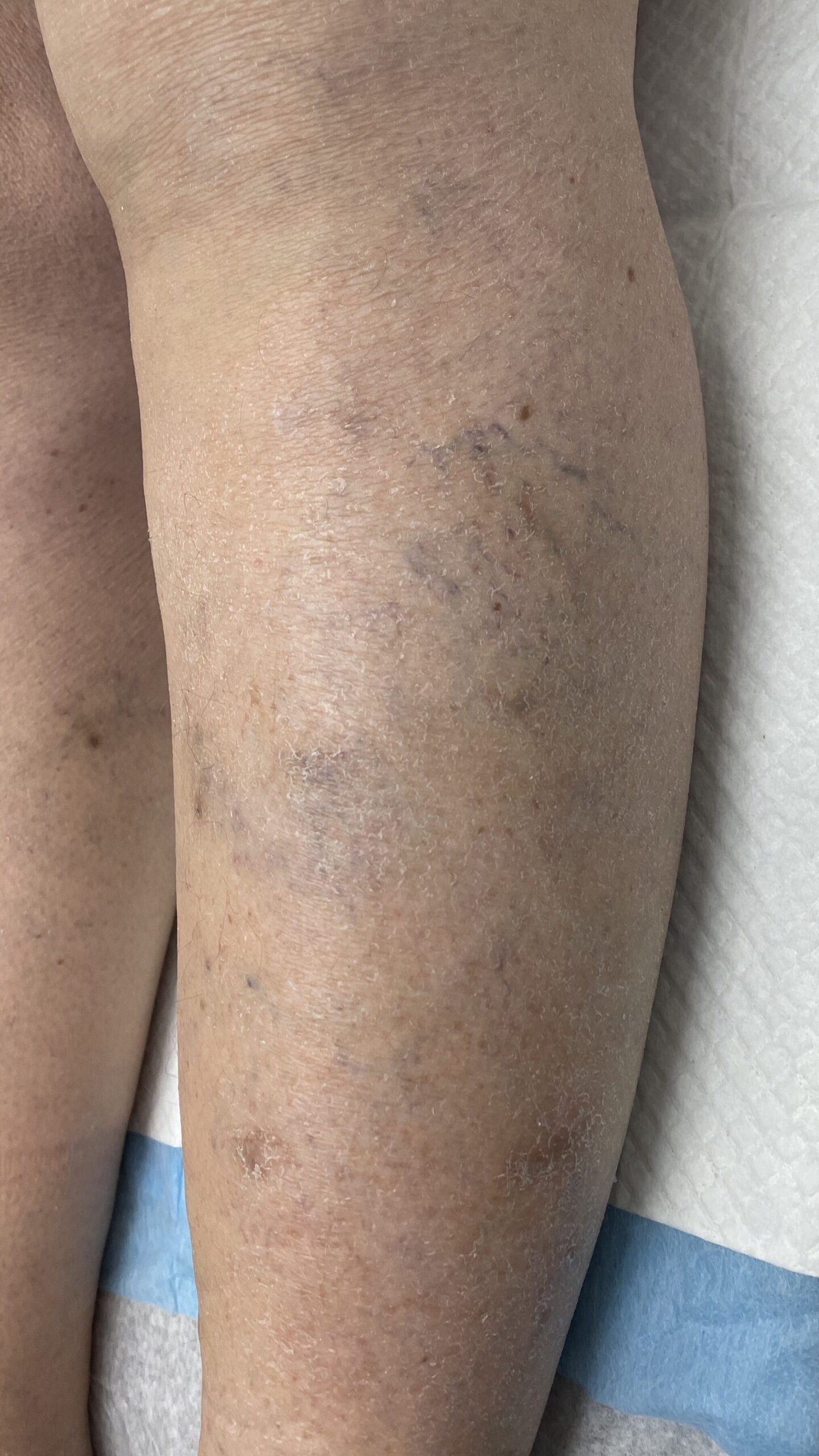 4 weeks after injection — left lateral leg