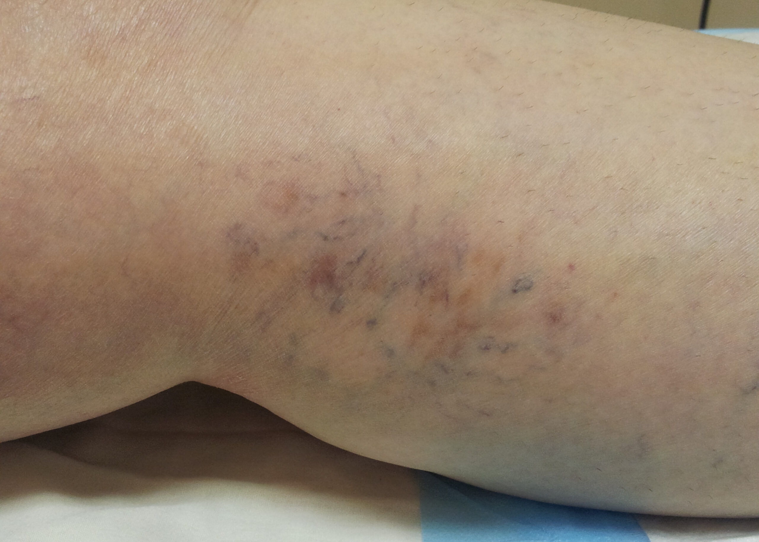 Varicose Veins — Four weeks after treatment