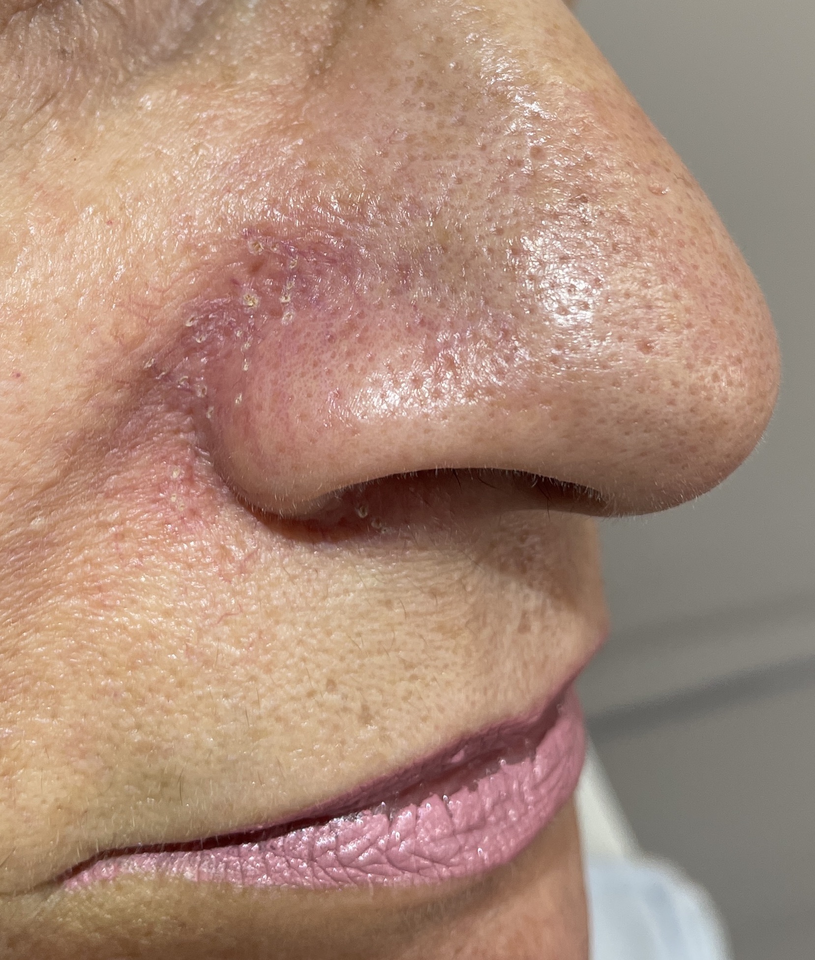 Paranasal Spider Vessels — Electrocautery — Immediately after treatment