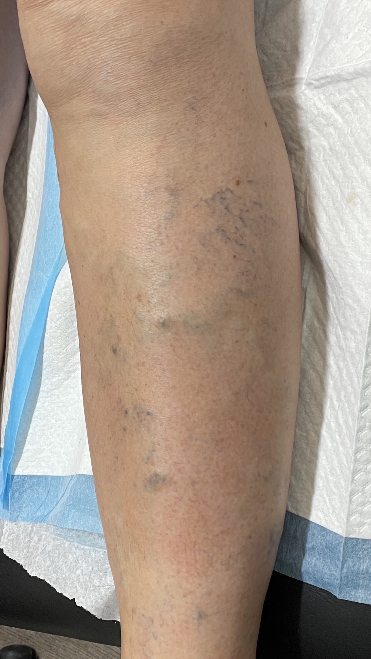 Baseline — left lateral leg