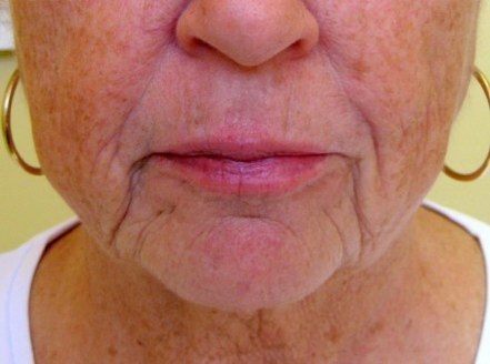 Botox & Dermal Fillers — Baseline