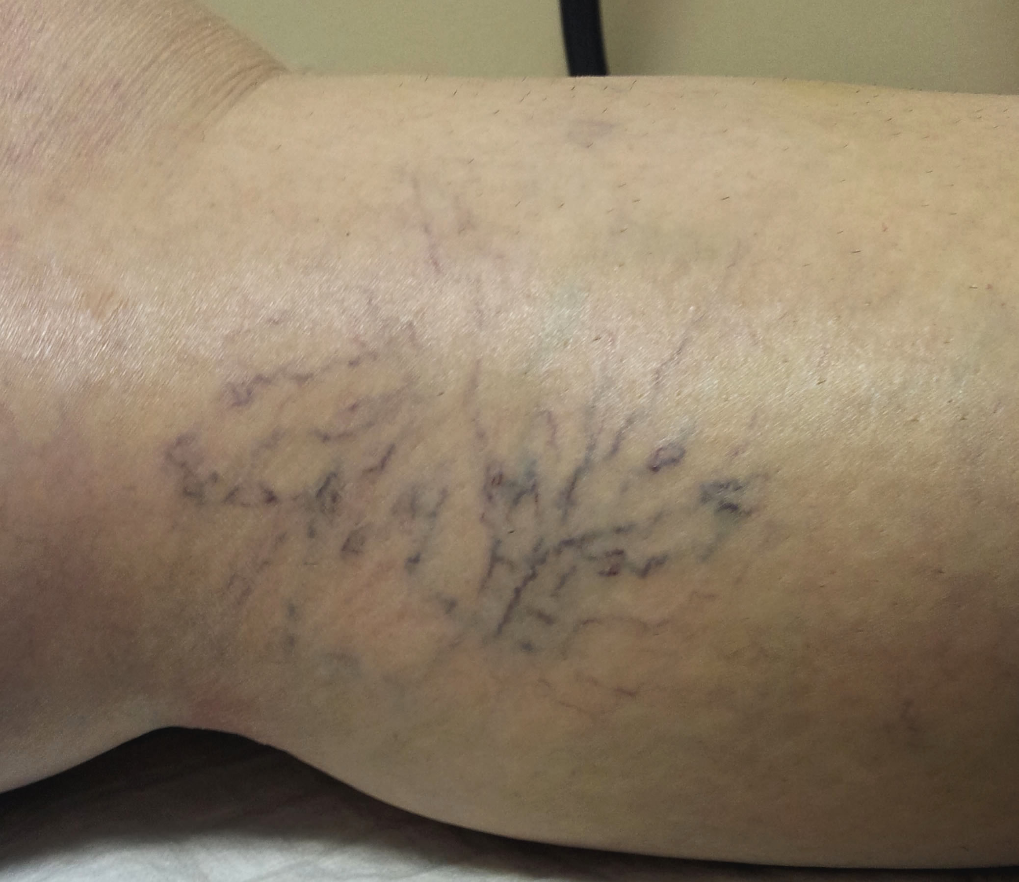Varicose Veins — Baseline — left medial leg