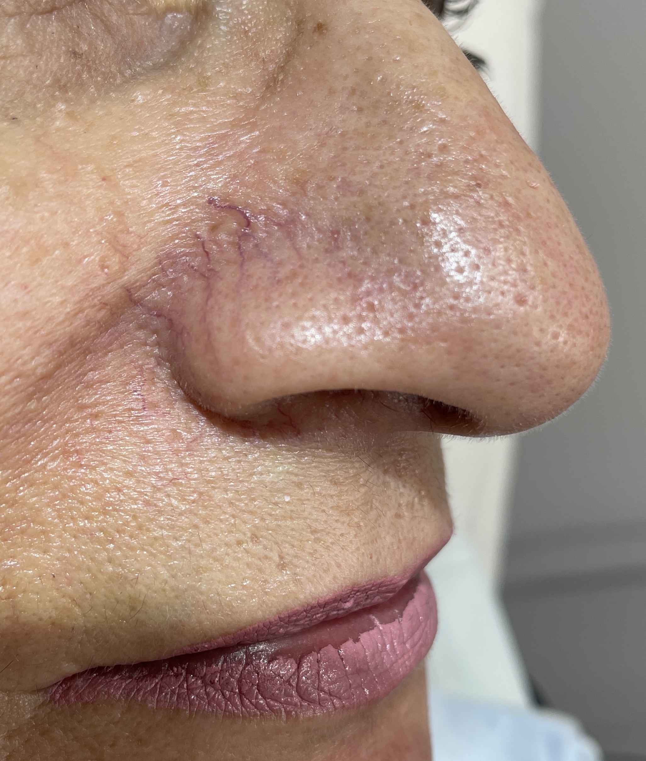 Paranasal Spider Vessels — Electrocautery — Baseline